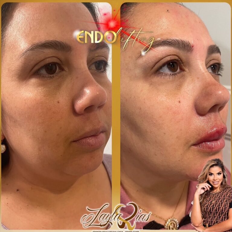 O que é Endolifting - Especialista- Lasers, Preenchimento e Botox São Paulo